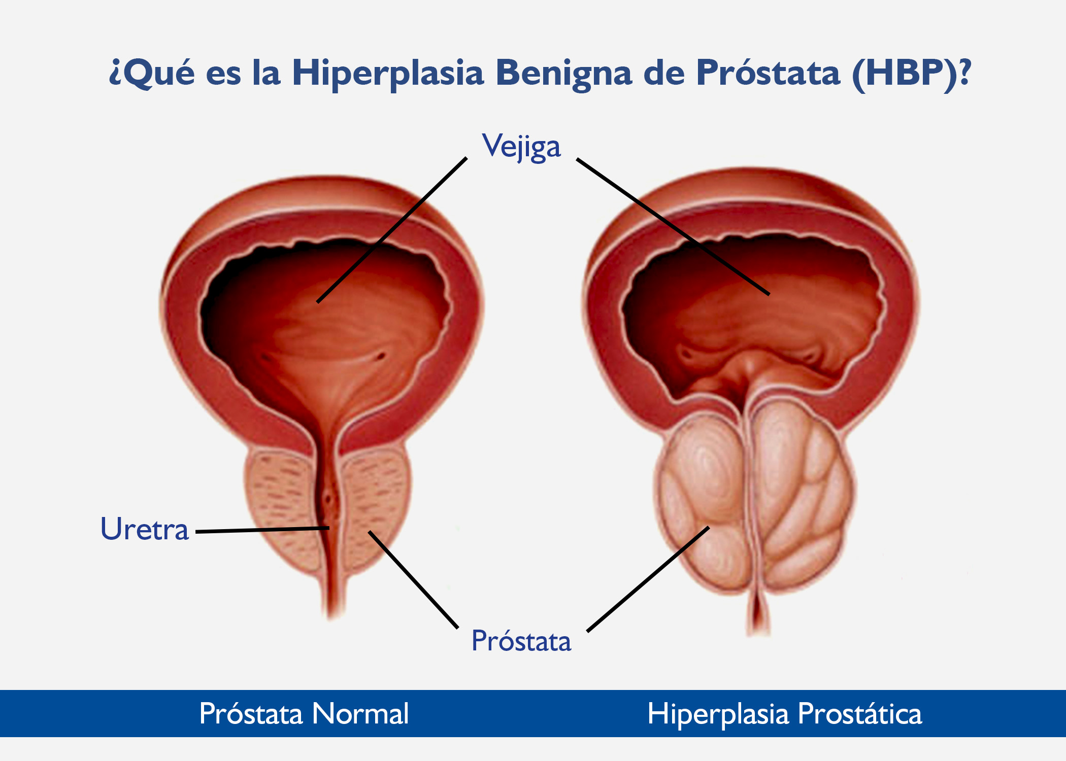 ¿Qué es la Hiperplasia Benigna de Próstata (HBP)?